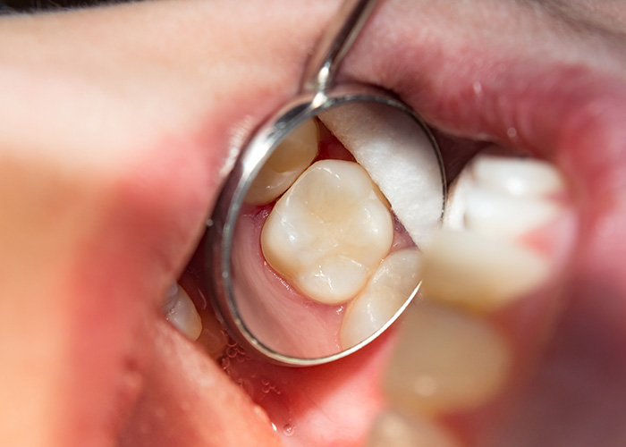 Texas Super Smiles for Kids | Teeth Whitening, Fluoride Treatment and Cosmetic Dentistry