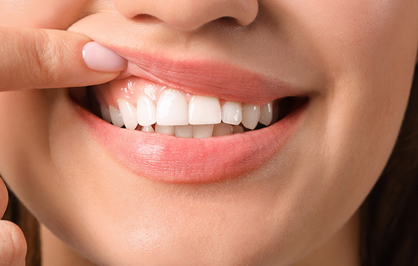 Texas Super Smiles for Kids | Preventative Program, Dental Sealants and Fluoride Treatment