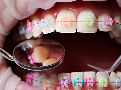 Texas Super Smiles for Kids | Dental Sealants, Teeth Bleaching and Periodontal Treatment